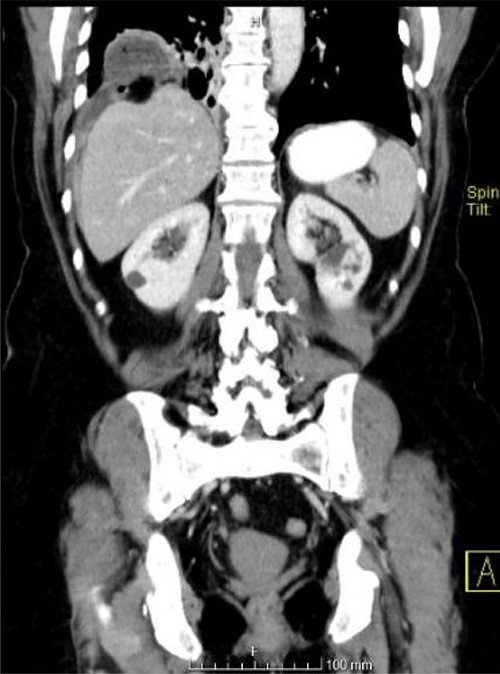 Coronal view showing a herniation of a loop to the chest.