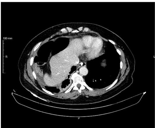 Axial view with evidence of Chilaiditi sign.