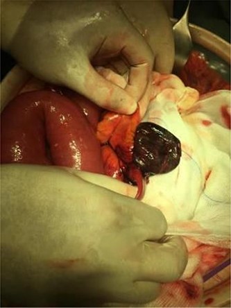 Necrotic jejunal loop.