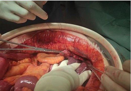 Diaphragmatic orifice closure.