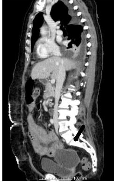 Sagittal view showing pelvic abscess; black arrow.