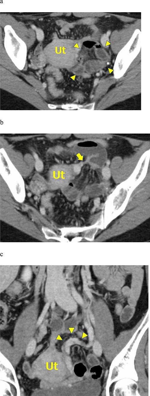 a. Contrast-enhanced axial CT showing fluid-filled dilated small bowel loops in the posterior pelvic cavity (arrowheads). The small bowel loops compressed the uterus on the right side. b. Contrast-enhanced axial CT showing mesenteric vessels converging around the uterus (arrow). c. Contrast-enhanced coronal CT images showing the left ovarian venous dilatation and tortuousness (arrowheads).