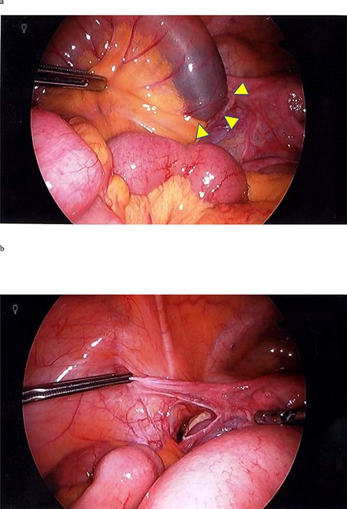 a. A laparoscopic image showing a fissure on the left side of the broad ligament. Arrowheads indicate the position where the small intestine entered. The oral side was dilated. b. A laparoscopic image showing a defect in the left broad ligament.