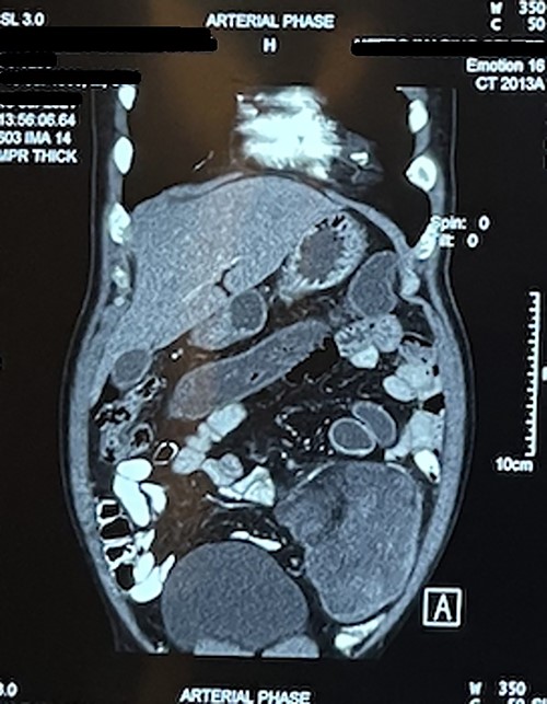 CT abdomen showing mass in coronal cut.