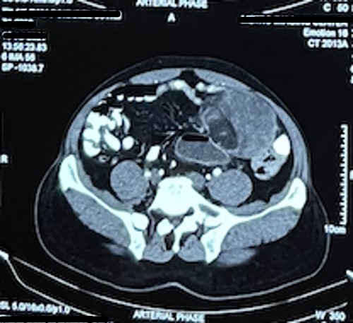 CT abdomen image of the mass in the transverse cut.