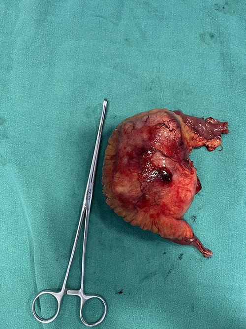 Resected mass along with the mesentery and ileum.