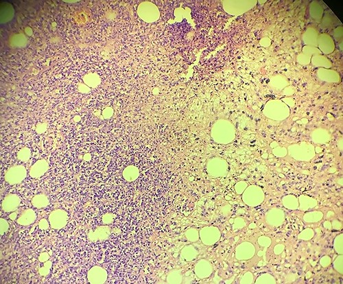 Histopathology of the mass showing area of necrosis.