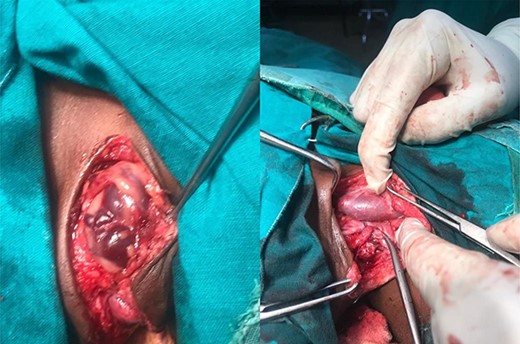 Lesion within the neck, before (left) and after dissection.