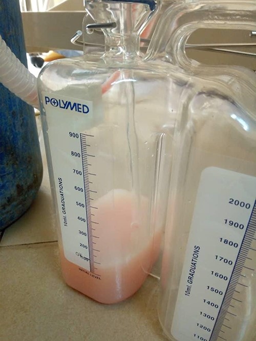 Collection chamber filled with 100 ml of chyle.