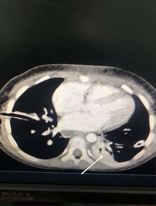 Axial Slice of the thorax showing bilateral thoracostomy tubes and minimal fluid on the left side (white arrow).