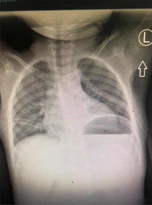 Control Chest X-ray showing resolution of the chylothorax with thoracostomy tubes in situ.
