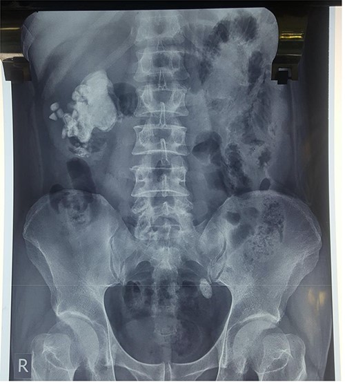 Plain X-ray KUB displaying a giant right-sided staghorn calculus surrounded by smaller secondary calculi along with a 2 cm calculus located in the distal third of the left ureter, at the inferior border of the sacroiliac joint.