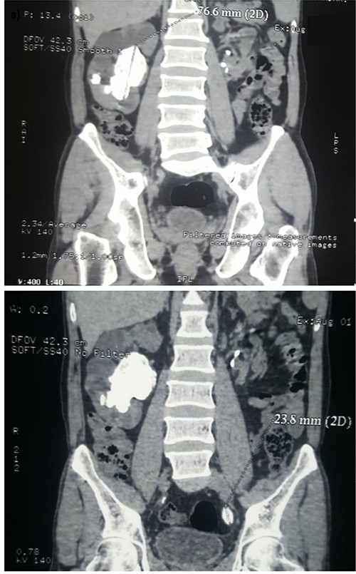 Coronal view of a non-contrast CT scan demonstrating (a) a 77.6 mm staghorn calculus occupying the right renal pelvis, surrounded by smaller calculi and (b) a 23.8 mm solitary calculus in the left distal ureter.