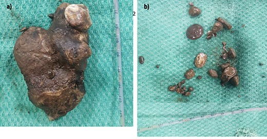 Photographic evidence of (a) the staghorn calculus being removed in one piece and (b) the smaller secondary calculi surroundingit.