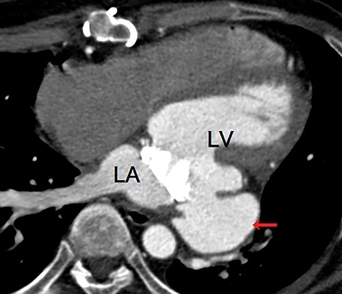 Enhanced computed tomography showing a left ventricular pseudoaneurysm (arrow) just below the mitral valve annulus. LA, left atrium; LV, left ventricle.
