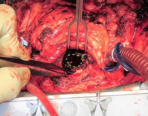 Intraoperative images obtained from the surgeon’s perspective. The orifice of the pseudoaneurysm (surrounded by a dashed circle) was found through the mitral annulus after removing the prosthetic valve.