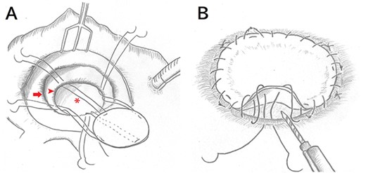 Intraoperative schema after a right-sided left atriotomy. (A) After removing the prosthetic mitral valve and visualizing the aneurysm orifice, four everting mattress stitches with 4–0 polypropylene are placed to fix the orifice of the aneurysm with a bovine pericardial patch at 90° intervals. (arrow, mitral valve annulus; arrow head, aneurysm orifice; asterisk, aneurysm) (B) Running sutures are performed to bind the edge of the orifice and the patch. Before tying the last sutures, BioGlue is injected and filled into the aneurysm.