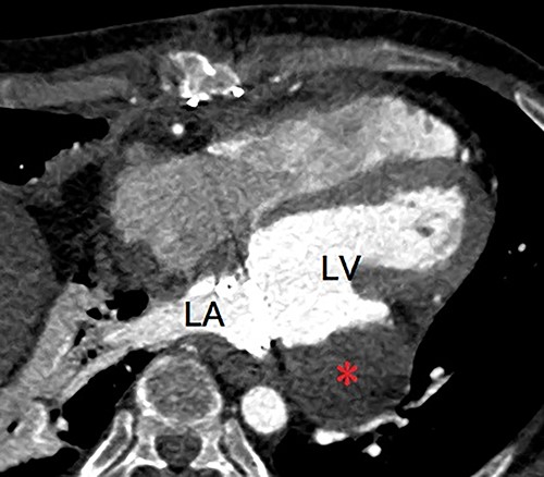 Postoperative enhanced computed tomography showing absent flow into the pseudoaneurysm (asterisk). LA, left atrium; LV, left ventricle.