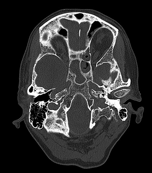 CT head revealed no signs of meningeal or intracerebral enhancement to suggest an intracranial abscess or cerebritis, but it suggested significant opacification in the paranasal sinuses, particularly in the ethmoid and sphenoid sinuses, most likely indicating a minor post-operative haemorrhage.