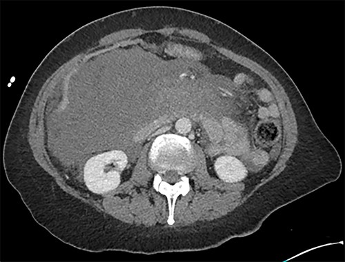 Axial image of the large retroperitoneal haematoma in portal venous phase.