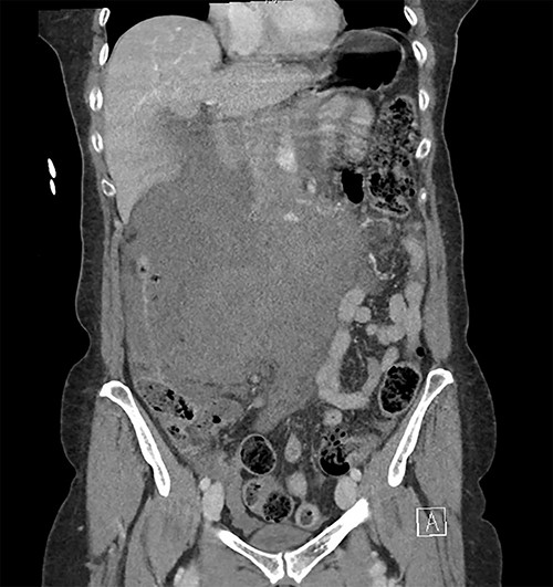 Coronal image of the retroperitoneal haematoma in portal venous phase.