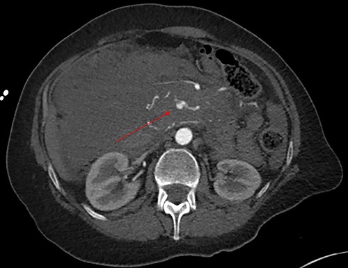 Axial image with arterial phase, demonstrating the pseudoaneurysm arising from a branch of the SMA. There is no active arterial blush.