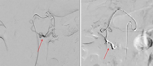 Pre-embolization (left) and post-embolization with coils (right).