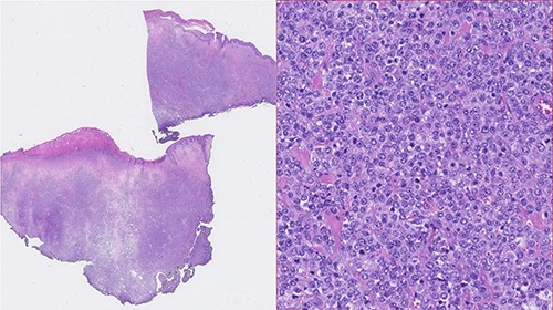 Photomicrographies. Left: Small magnification (HE) of a fragment of skin and subcutaneous tissue, with extensive epidermal ulceration and almost total occupation of the subcutaneous tissue by lymphoid tissue placed in a towel. Right: High magnification (HE ×40) with cytological detail of the lymphoid infiltrate, consisting of towels of voluminous cells with centroblastic morphology.