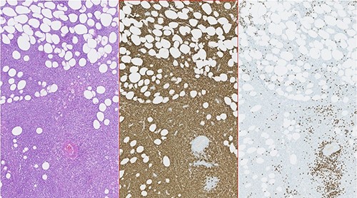 Photomicrographies. Left: HE ×5, with an area of hypodermic adipose tissue infiltrated by the neoplastic lymphoid population. Center: Immunohistochemical staining of the same area, revealing diffuse expression of CD20 by neoplastic lymphoid cells. Right: Absence of CD3 expression in the neoplastic cell population and expression only in a small amount of dispersed reactive T lymphocytes.