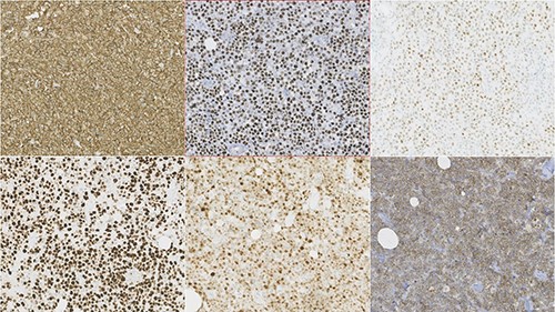 Photomicrographies. Lymphoid infiltrate immunophenotype, with a diffuse expression of CD20, bcl6, C-Myc (upper half from left to right), and Ki67, MUM1 and CD10 (lower half from left to right).