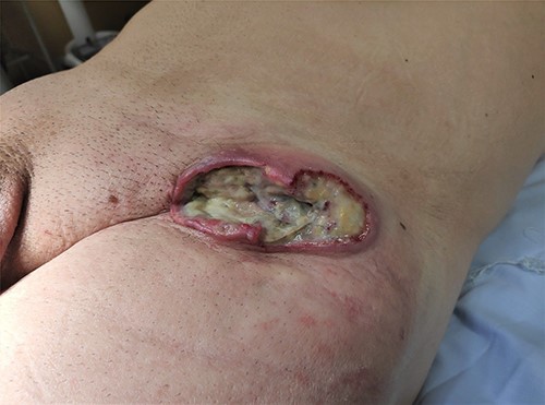 PCBCL at the site of the previous hernioplasty.