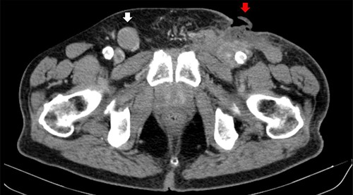 Computerized tomography image. Right inguinal adenopathy (white arrow) and PCBCL (red arrow).