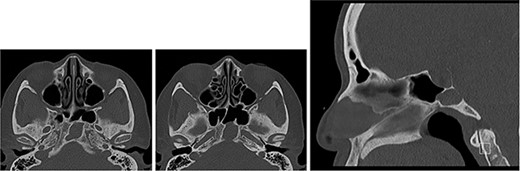 CT of the base of skull (axial images ×2 and sagittal image) showing sphenoid mucocele and paper-thin posterior cortex.