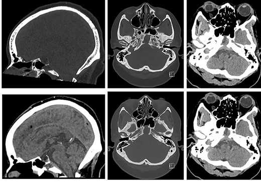 CT of the head (left: sagittal bone and soft tissue windows, and, right: axial bone window and soft tissue window at the same levels ×2) showing sphenoid mucopyocele, retroclival dural thickening and increasing clival dehiscence (anterior and posterior cortex).
