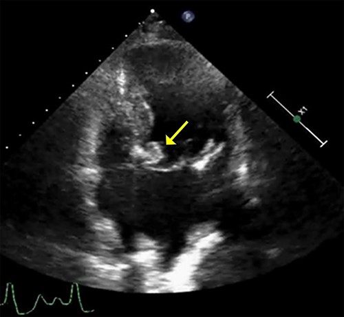 Transthoracic echocardiogram. A well-defined densely calcified mass noted on the anterior mitral leaflet in the apical four-chamber view.