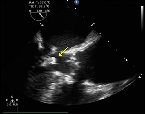 TEE in the left ventricular outflow tract view shows an echo-dense mass measuring ~12.8 mm × 12.9 mm arising from mitral annular calcification.