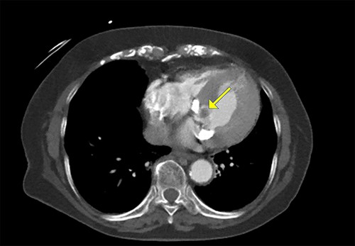 Cardiac computed tomography showing a cardiac mass in the mitral annulus with heavy mitral annular calcification.