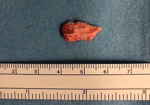 Gross appearance of the resected tumor.