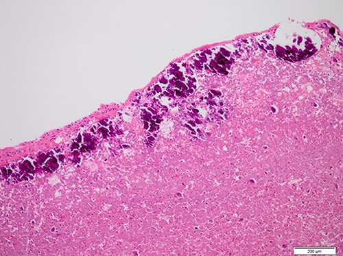 Histopathological appearance of the tumor; fine deposits of calcium surrounding the central part of the tumor, which consists of an eosinophilic muddy substance (Hematoxylin and eosin staining, ×10).