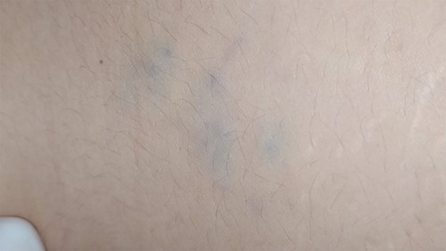 A blue-red painful soft mass on the patient’s left buttock.