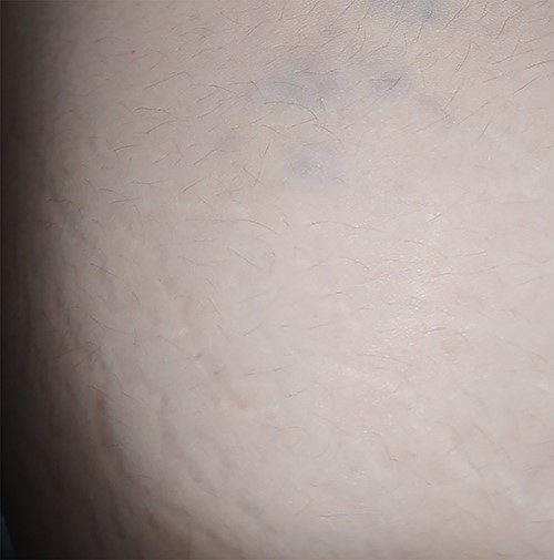 A similar blue-red painful soft mass was detected on her left thigh.