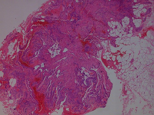 Hematoxylin and Eosin ×40: pieces of neoplasm with adjacent fatty tissue.