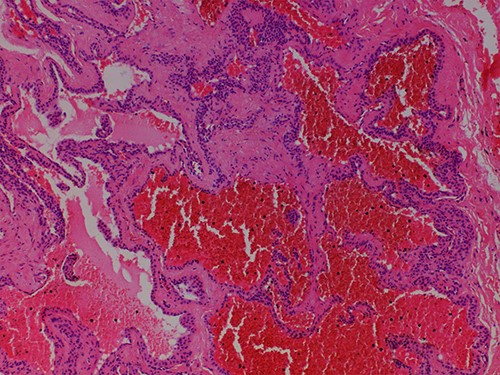 Hematoxylin and Eosin ×100: dilated vessels surrounded by collars of glomus cells with adjacent hyalinized stroma.