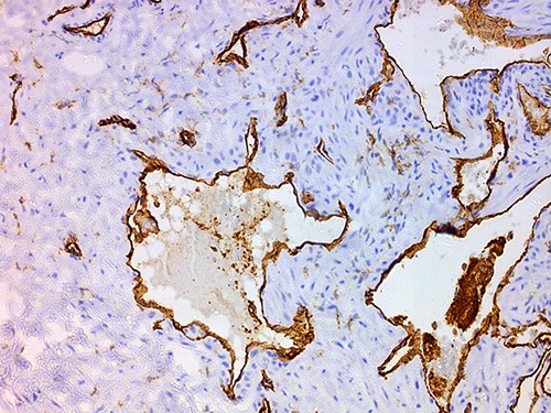 CD31 ×100: endothelial cells express CD31 whereas neoplastic surrounding cells do not.