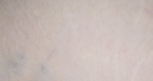 Another similar mass found on the patient’s lower back.