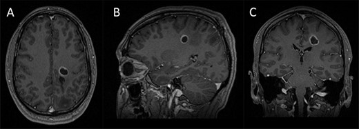 Preoperative imaging; (A–C) axial, sagittal and coronal T1-wieghted magnetic resonance imaging (MRI) images, with gadolinium demonstrating a contrast enhancing lesion in the left corona radiata.