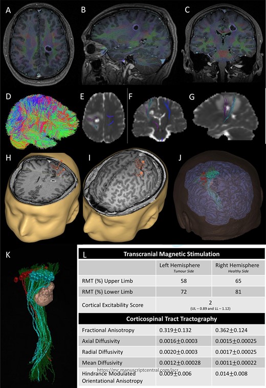 Integrated preoperative anatomical and functional brain mapping; (A–C) axial, sagittal and coronal fusion of T1-weighted MRI images with gadolinium and first eigenvector fractional anisotropy (FEFA); (D) whole brain tractography performed with StarTrack and visualized in TracViz according to deterministic spherical deconvolution algorithm. (E–G) fusion of CST with the ADC map; (H and I) nTMS mapping of the upper and lower limbs with hotspots for both upper and lower limbs identified with a marker (orange); (J and K) 3D Modelling of the tumour and the cortical and subcortical mapping of the CST with Stealth S8; (L) table summarizing the nTMS variables (resting motor threshold—RMT—and Cortical Excitability Score—Number of abnormal interhemispheric RMT ratios) and the tractography metrics.
