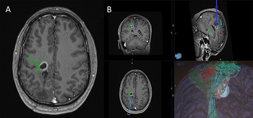 (A) Axial T1-weighted image with gadolinium showing the lesion with imposed DTI tractography of the CST; (B) planned trajectory for insertion of the tubular retractor guided by the preoperative integrated anatomical and functional motor mapping.