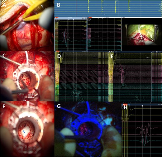 Intraoperative technical illustration: (A) transsulcal approach; (B) subdural strip of electrodes placed under preoperative nTMS and DTI guidance with stable responses at 7 mA; (C) docking of the BrainPath tubular retractor with positive responses of the anterior tibialis at 17 mA during the cannulation of the brain, insertion stopped at this point; (D) stimulation through the tube identified motor responses at 17 mA from lower limb muscles (tibialis anterior and abductor hallucis); (E) direct subcortical stimulation identified motor responses from upper and lower limb muscles at 7 mA; (F and G) Tumour subtotal resection stopped at 5 mA for the upper limb and 7 mA for the whole CST. The tumour demonstrated 5-ALA-induced fluorescence under the BLUE 400 filter; (H) activity from hand muscles at 5 mA threshold during removal of BrainPath tubular retractor before closure.
