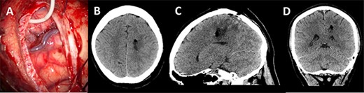 Post-operative imaging; (A) post-decannulation brain surface after transsulcal approach; (B–D) axial, sagittal and coronal CT images showing collapse of the surgical tract and no overt complications.